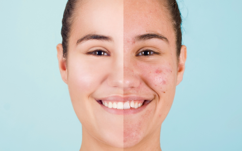 What You Need to Know About the 6 Different Types of Acne⁠